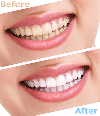 The image shows a side-by-side comparison of a person's teeth before and after a dental treatment, with the text 'BEFORE' and 'AFTER' clearly indicating the transformation.